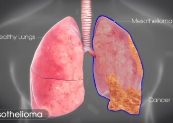 Mesothelioma: Symptoms, Causes, and Treatment - Scientific Animations