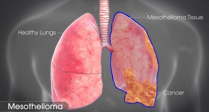 Mesothelioma: Symptoms, Causes, and Treatment - Scientific Animations